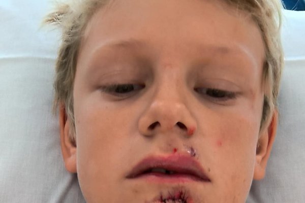 Tíu ára drengur illa útleikinn: „Dekkið hafði verið losað á hjólinu hans“