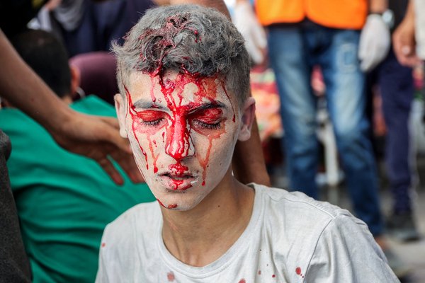 An injured Palestinian youth reacts following an Israeli strike in Gaza City in the central Gaza Strip, on July 2, 2025, amid the ongoing conflict between Israel and the Palestinian Hamas militant group. (Photo by Omar AL-QATTAA / AFP)