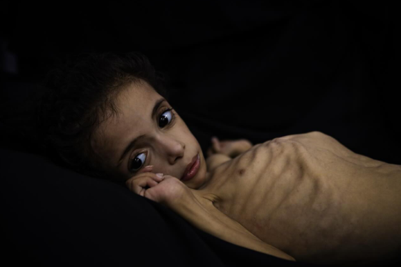 Fjögurra ára palestínsk stúlka deyr úr vannæringu