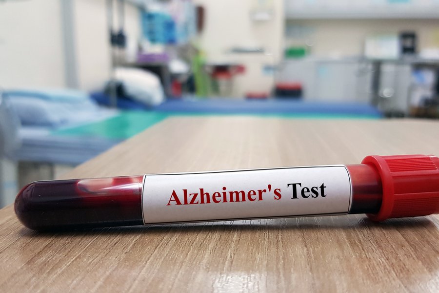 Alzheimer-sjúkdómurinn gæti átt upptök sín utan heilans