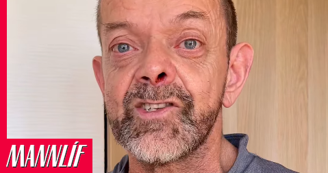 Guðmundur Felix sýnir árangurinn eftir erfiða aðgerð